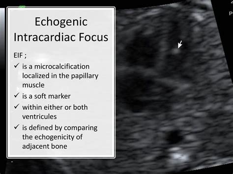 echogenic intracardiac focus worry.